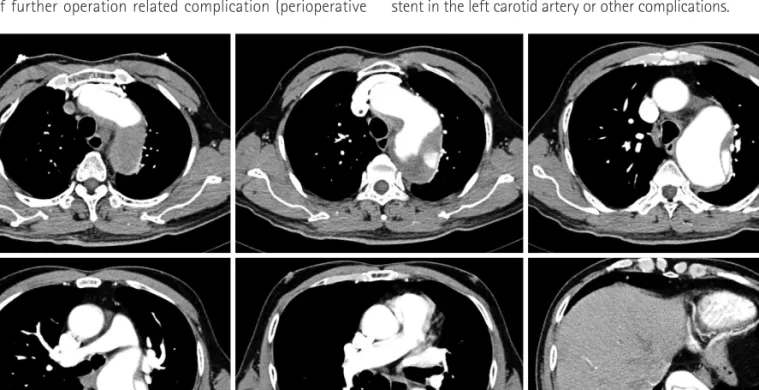 Fig. 3. The CT scan revealed a Stanford type B aortic dissection combined with a huge aneurysmal dilatation for which the entry site was the aortic arch  level and the aneurysm extended to the infrarenal level and ran to the common iliac artery.