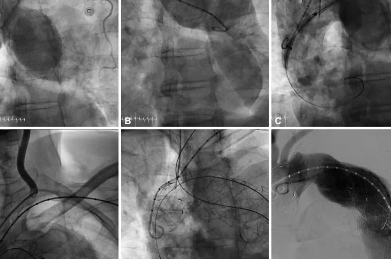 Fig. 4. The overall procedure of the patient. A and B: the aortogram before stent graft deployment; the proximal entry tear was distal to the LSCA and  there was a huge aneurysm