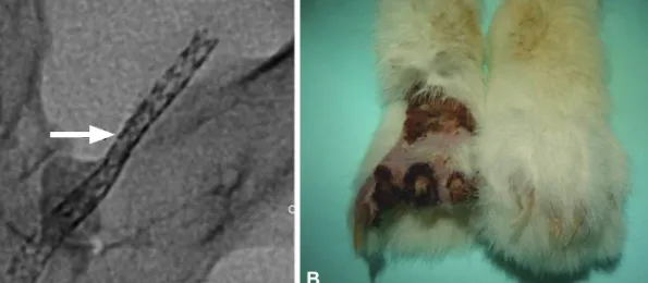 Fig. 1. A representative case of stent fracture, associated occlusion and ischemic necrosis