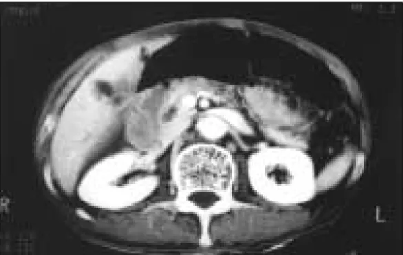 Fig 3.  An  intraoperative  cholangiogram  through cystic duct obtained in a 78 year old male with  abrupt  obstruction  in  proximal common bile duct.