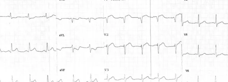 Fig. 1. Initial electrocardiogram (case 1).