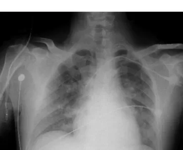 Fig. 2. Chest radiogram showing sign of pulmonary edema.