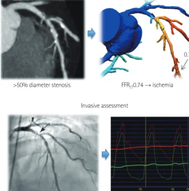 Fig. 3. Correlation between iFR and FFR according to the coronary artery  (data from ADVISE study, courtesy of Justin Davies, MD)