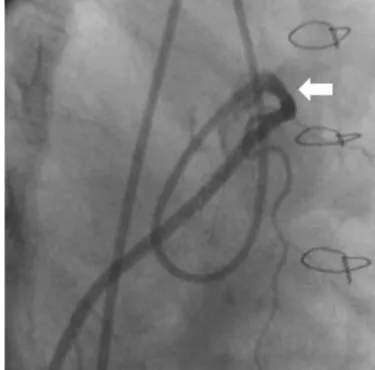 Fig. 3. Right coronary angiography. Baseline coronary angiogram showed  an anomalous right coronary artery (RCA) ostium and subtotal occlusion of  the proximal RCA (arrow).