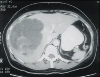 Fig.  1.  Abdominal  CT  scan  shows  well  dermarcated,  multiple  sepa- sepa-rated  cystic  mass  with  papillary  growing  solid  portion.