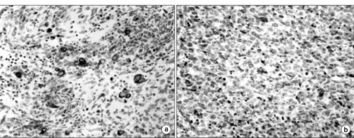 Fig.  6.  Abdominal  CT  scan  (after  13  months)  showed  about  12  cm  sized  heterogenous  low  attenuating  mass  invading  right  kidney  and  perirenal  space.