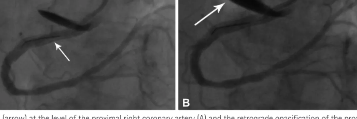 Fig. 1. The dissection line (arrow) at the level of the proximal right coronary artery (A) and the retrograde opacification of the proximal segment of the as- as-cending aortic wall (false lumen) (arrow) highlighting the aortic dissection (B).