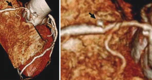 Fig. 1. Baseline three-dimensional reconstruction image of computed tomography coronary angiography
