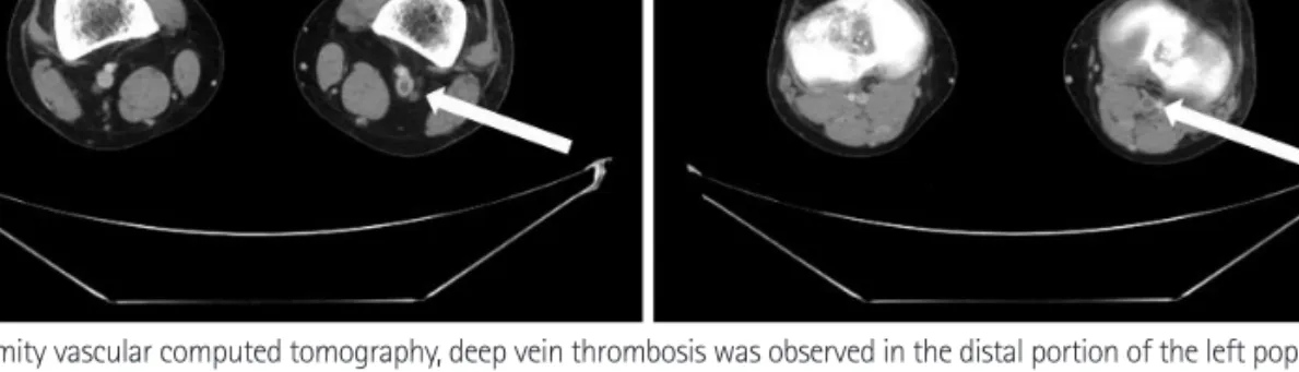 Fig. 3. In the lower extremity vascular computed tomography, deep vein thrombosis was observed in the distal portion of the left popliteal vein (white arrows).