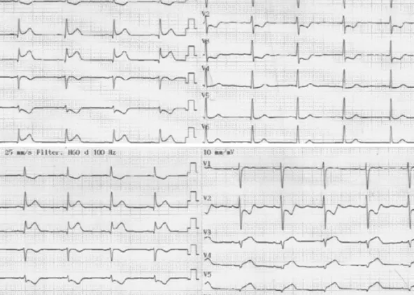 Fig. 1. Electrocardiography showing ST-segment elevation in the inferior leads (II, III, aVF) (A), and ST-segment elevation in the reverse precordial leads  (V3R, V4R, V5R, V6R) (B).
