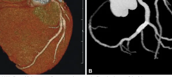 Fig. 4. Contrast enhanced 320-slice multi-detector cardiac computed tomography. Note the absence of the right coronary artery ostium at right coronary  cusp (A) and the extended distal portion of the left circumflex artery with patent stent (B).
