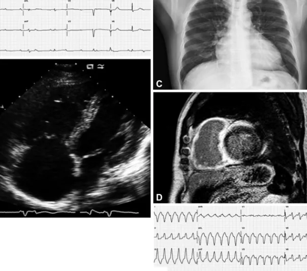 Fig. 1. Initial presentation of the patients. A: admission electrocardiogram: complete atrioventricular block (heart rate, 27 beats per minute)