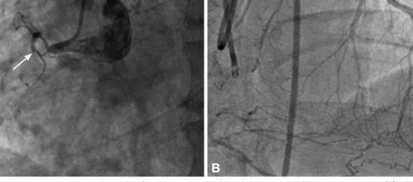 Fig. 1. Images of pre-interventional coronary angiography. Chronic total occlusion of the proximal right coronary artery (A) with grade 3 collateral flow  from the left anterior descending artery (B) revealed by coronary angiography