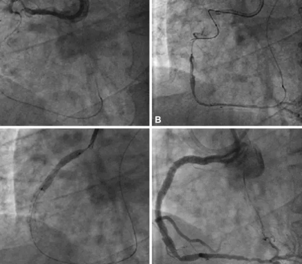 Fig. 3. ‘’Reverse CART technique’’. The wires pass via septal branch to mid-distal right coronary artery (RCA) via retrograde approach (A and B)