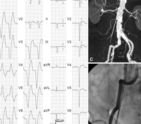 Fig. 1. Electrocardiograms and angiograms of the patient. A: a 12-lead electrocardiogram of initial ventricular tachycardia had configuration of a left bundle  branch block and left axis deviation