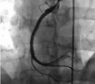 Fig. 2. Left anterior oblique view of a large thrombotic occlusion of the proxi- proxi-mal part of the right coronary artery.