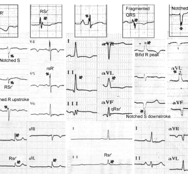Fig. 1. The various types of notched and fragmented QRS complexes. Different fragmented QRS complexes patterns were shown by arrows including rSr´,  rSR´, RSr´, notched R up-stroke, notched S down-stroke, bifid R peak and bifid R nadir.