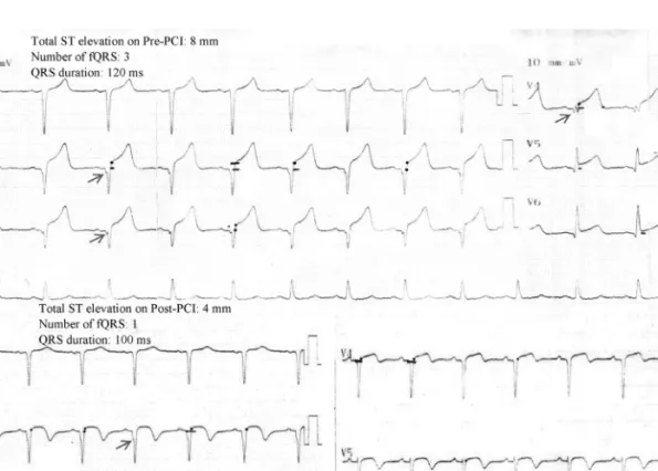 Fig. 2. Changes in fragmented QRS complexes on surface electrocardiogram before and after primary percutaneos coronary intervention.