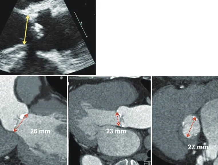 Fig. 2. Annulus size measurement using echocardiography (A) and computed tomography (B, C and D)