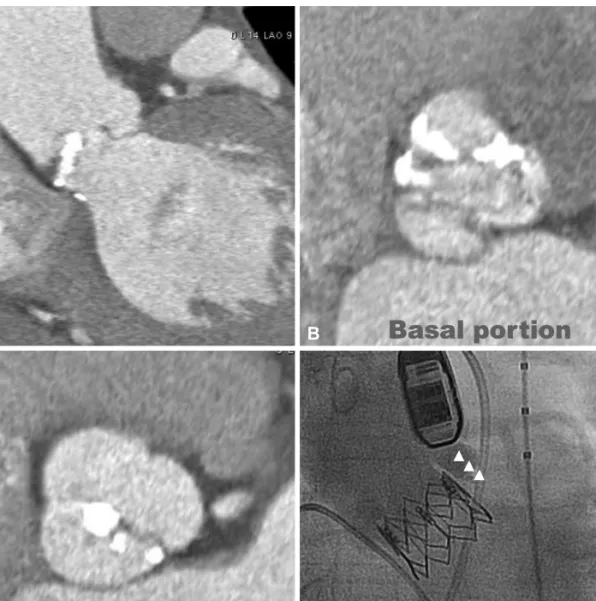 Fig. 6. An embolized case; computed tomography showed heavy calcific leaflets in the noncoronary cusp (A: coronal view, B: basal portion of valve, C: top  of valve); aortic root angiography showed incomplete coverage of the noncoronary cusp due to heavy ca