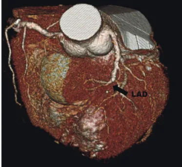 Fig. 2. Chest computed tomography shows the rupture on the apex of left  ventricular wall.