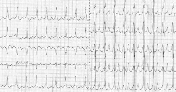 Fig. 4. Programmed atrial pacing from right atrium (left) and coronary sinus (right). A duodecapolar catheter was located in the right atrium (Halo)