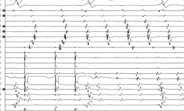 Fig. 5. Programmed atrial pacing on the proximal coronary sinus area induced typical atrial flutter