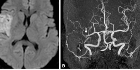 Fig. 1. Brain MRI and MRA. A: brain MRI reveals a high signal intensity lesion in the right middle cerebral artery in the diffusion image (arrow)