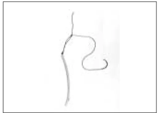 Fig. 2. After the common bile duct was cleaned, a 5 mm  choledochoscope  was  introduced  into the common bile duct and a guide wire was advanced  through  the  working  channel  of the choledochoscope.