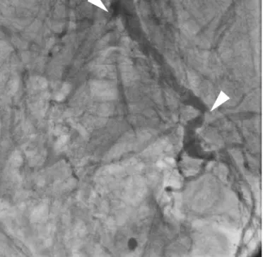 Fig. 3. Transbrachial peripheral angiography demonstrates total occlusion of  right common iliac artery (arrow) and left external iliac artery (arrowhead).