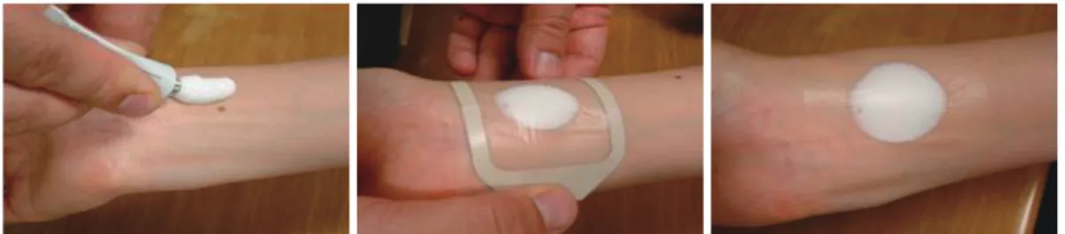 Fig. 1. Application of eutectic mixture of local anesthetic cream on radial artery puncture site.