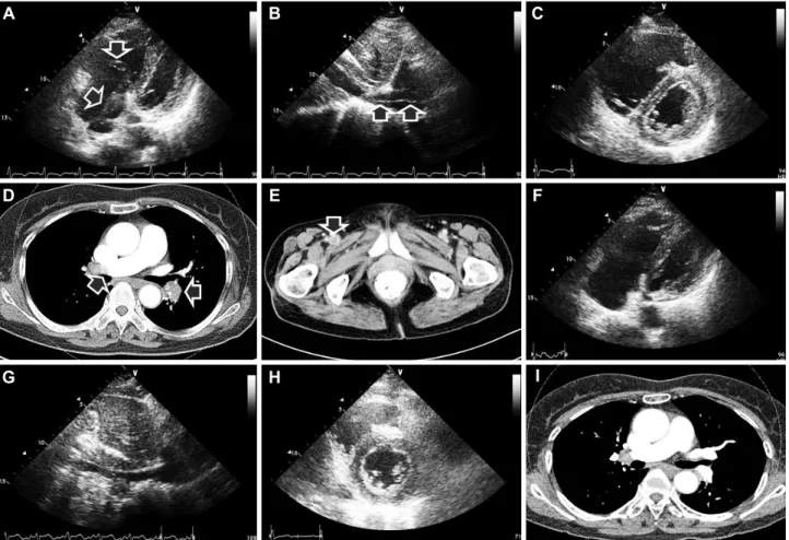 Fig. 1. Representative echocardiography and computed tomography images at initial presentation (A-E) and at follow-up (F-I)