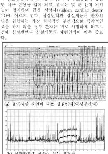Fig. 2. ECG (ElectroCardioGram signal)