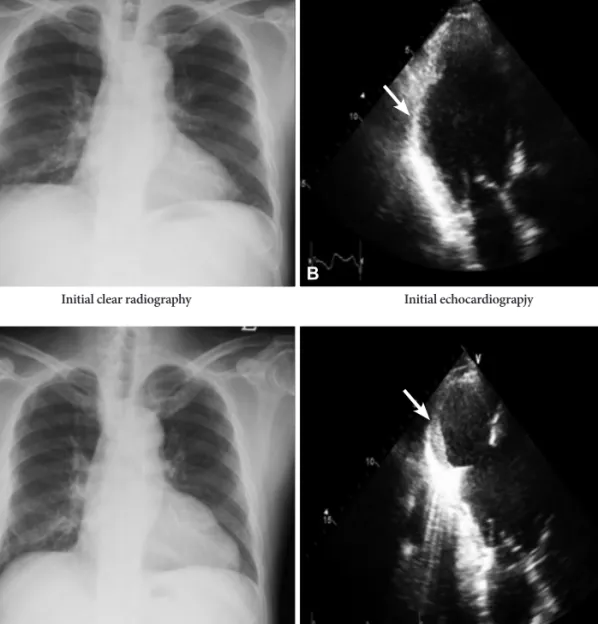Fig. 1. A 55-year-old man with asymptomatic left ventricular pseudoaneurysm.