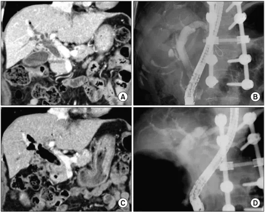 Fig. 1. The preoperative finding  of Case No. 1. Computed  tomo-graphy (CT) and endoscopic  retrograde  cholangiopancreato-graphy (ERCP) taken 7 years  before surgery (A, B) show  marked dilatation of the  com-mon bile duct with the patulous  sphincter