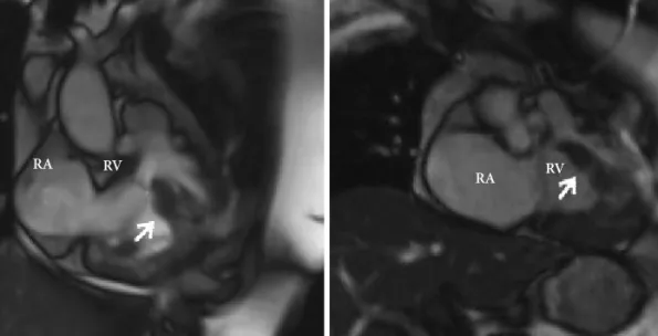 Fig. 4. Right ventriculogram demonstrating a severe hypertrophied  muscle bundle (arrow)