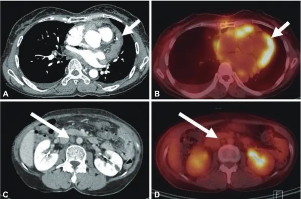 Fig. 4. A: microscopic examination showed abundant pleomorphic malignant cells with epithelial appearance (H&amp;E stain, ×400)