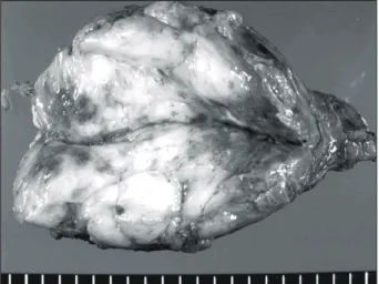 Fig.  3.  Histologic  finding  (H&amp;E,  ×400).  Spindle  shaped  tumor  cells  with  nuclear  pleomorphism  and  mitotic  features.