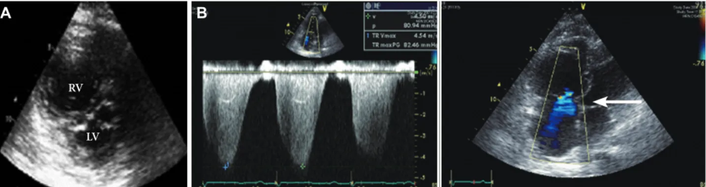 Fig. 5. Patientsʼ 2D echocardiogram revealed severe pulmonary hypertension, right ventricular dysfunction, and tricuspid regurgitation