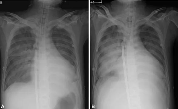 Fig. 1. Chest radiographs showing interval change over time since percutaneous cardiopulmonary support initiation