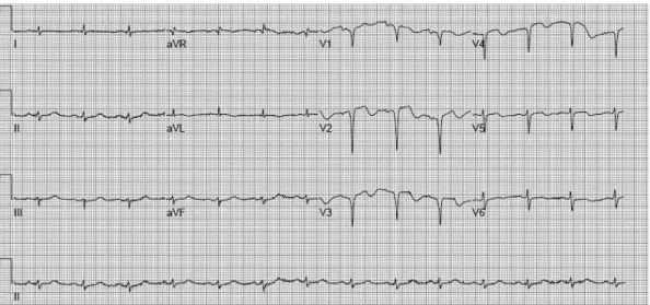 Fig. 1. First electrocardiogram at recorded in the emergency room; the Q wave was visible at on leads V1-4