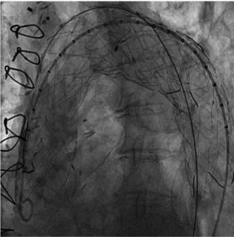Fig. 3. The aorta CTA one week after the de-brancing procedure. 