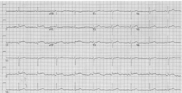 Fig. 2. Electrocardiogram showed ST-segment elevation in lead II, III and aVF.