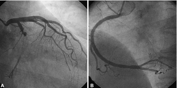 Fig. 3. Emergent coronary angiogram showed thrombotic total occlusion of the distal left circumflex artery due to drug-eluting stent thrombosis  (A), and patent right coronary artery bare metal stent (B).