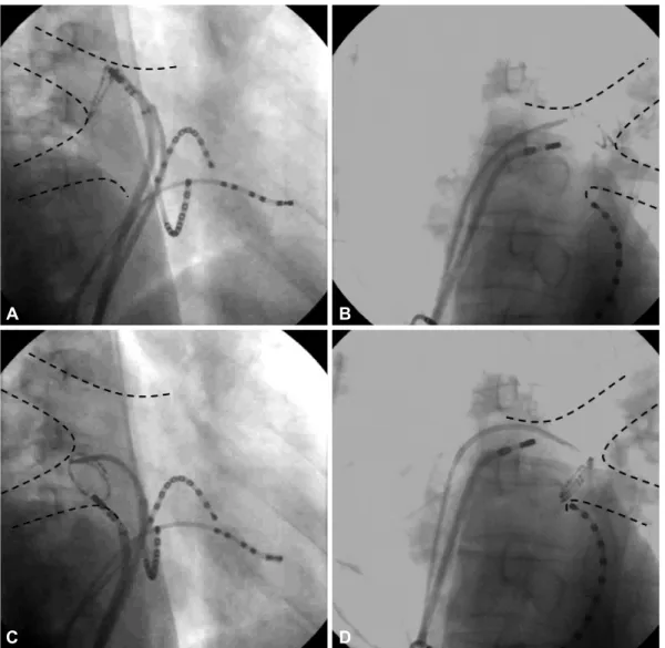 Fig. 2. Fluoroscopic image confirming the isolation of each pulmonary vein. A variable-sized Lasso catheter was used to verify conduction  block between the pulmonary vein and the left atrium
