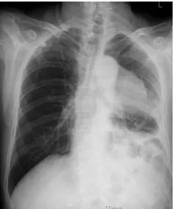 Fig. 2. The chest CT scan shows a saccular aneurysm with intramural thrombus in the aortic arch (A)