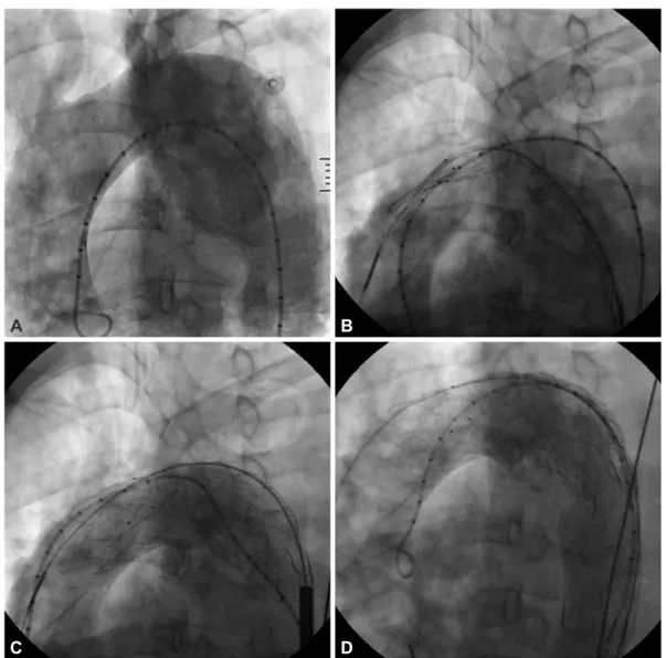 Fig. 4. The chest X-ray shows total atelectasis of the left lung (A). The left main bronchus is compressed due to the posteriorly displaced  left pulmonary artery, resulting in left lung total atelectasis on the chest CT scan (black arrow) (B) and there is