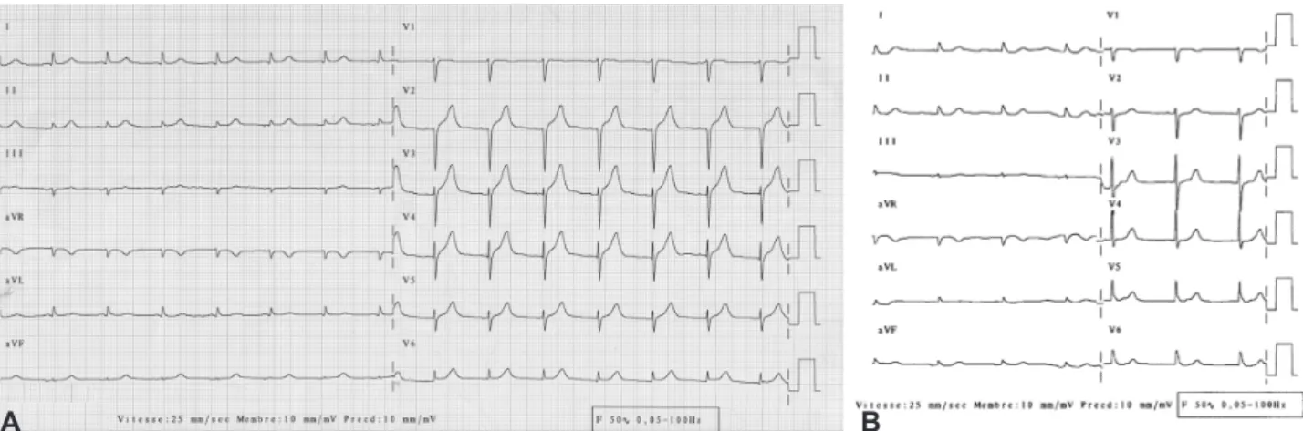Fig. 1. A: a per-critical electrocardiogram showing anterior ST-segment elevation. B: normal initial electrocardiogram.