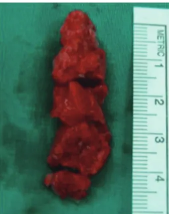 Fig. 5. Pathological specimens of the left ventricular thrombus af- af-ter left ventricular thrombectomy
