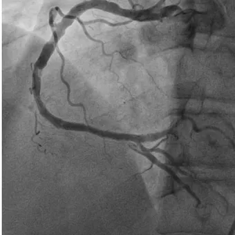 Fig. 3. Coronary angiogram after stent implantation demonstrates  adequate luminal diameter of distal right coronary artery but  re-sidual thrombus.